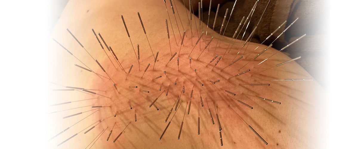 ルート鍼治療